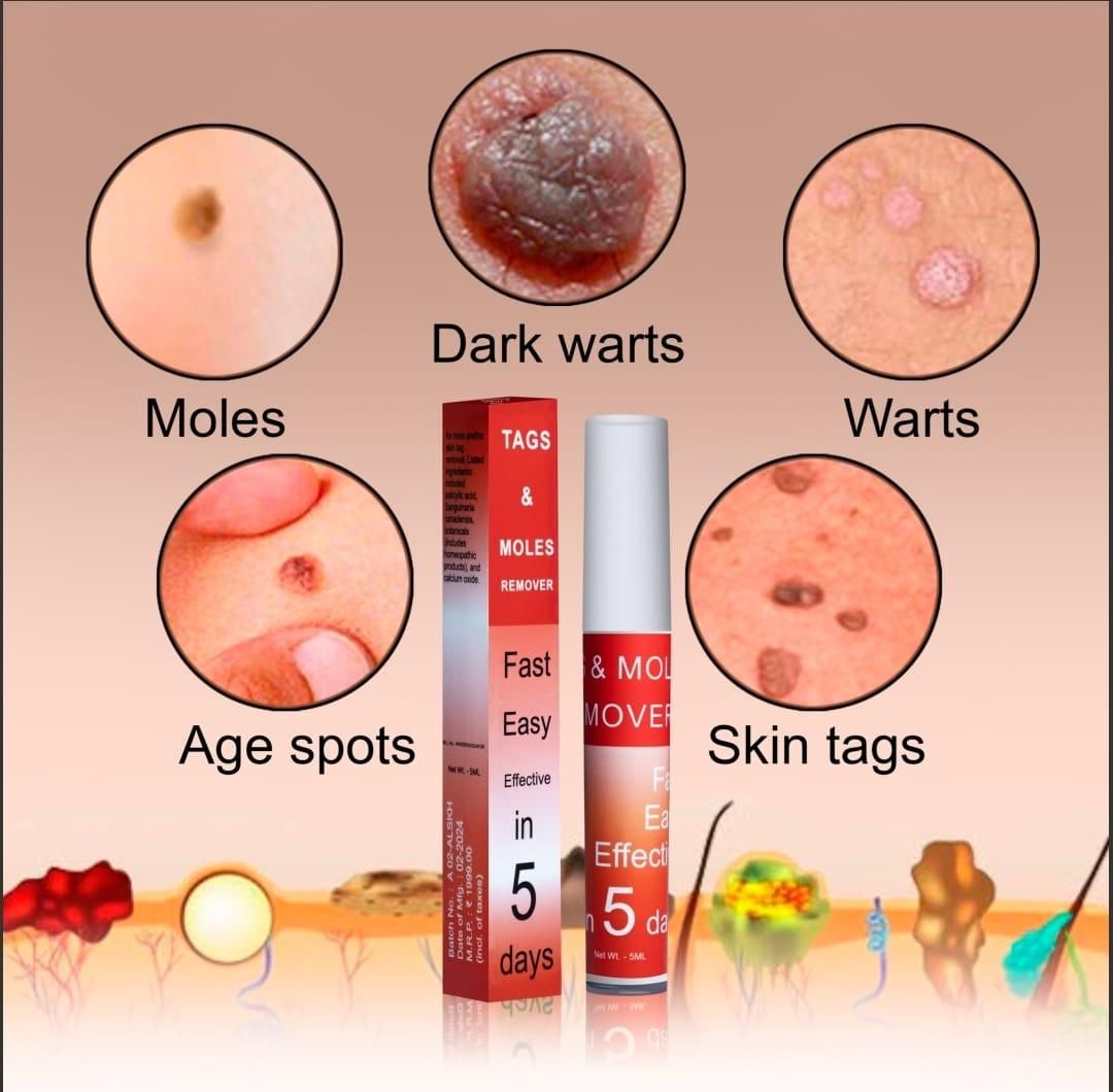 Tags & Moles Remover (Buy 1 Get 1 Free )