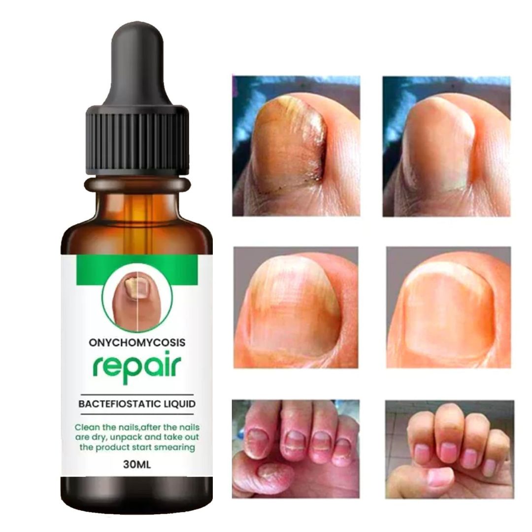 Nail Repair Serum (š¢Buy 1 Get 1 FREE)