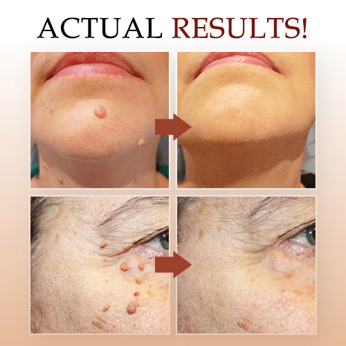 Tags & Moles Remover (Buy 1 Get 1 Free )