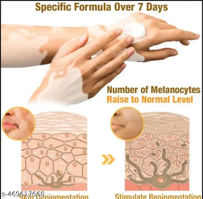 Vitiligo Bee Venom Treatment Cream (Pack of 2)