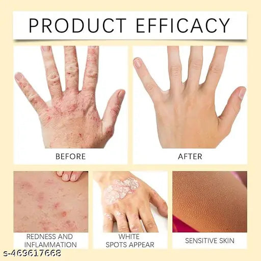 Vitiligo Bee Venom Treatment Cream (Pack of 2)